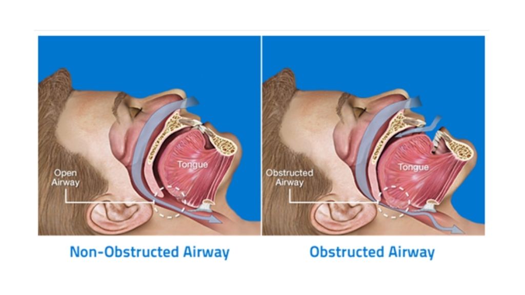 sleep apnea west kelowna